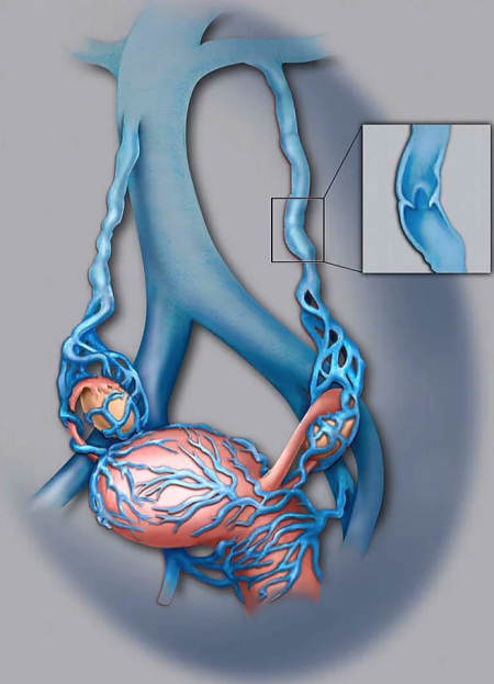 Embolización de varicocele o varices pélvicas / gonadales