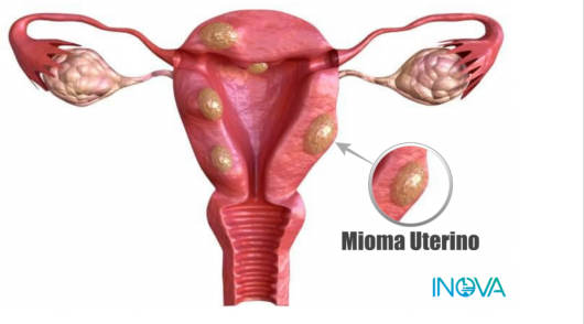 Embolización de miomas uterinos